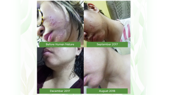 Find Out How This Blogger Turned Her Worst Breakout Around